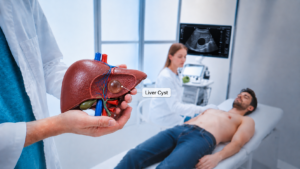 3D liver showing a hepatic cyst beside an ultrasound scan displaying a fluid-filled liver cyst.