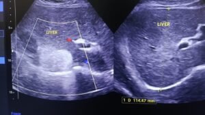 hepatic hemagioma on ultrasound showing the fetaures of sonography
