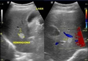 liver hemangiona on ultrasound 